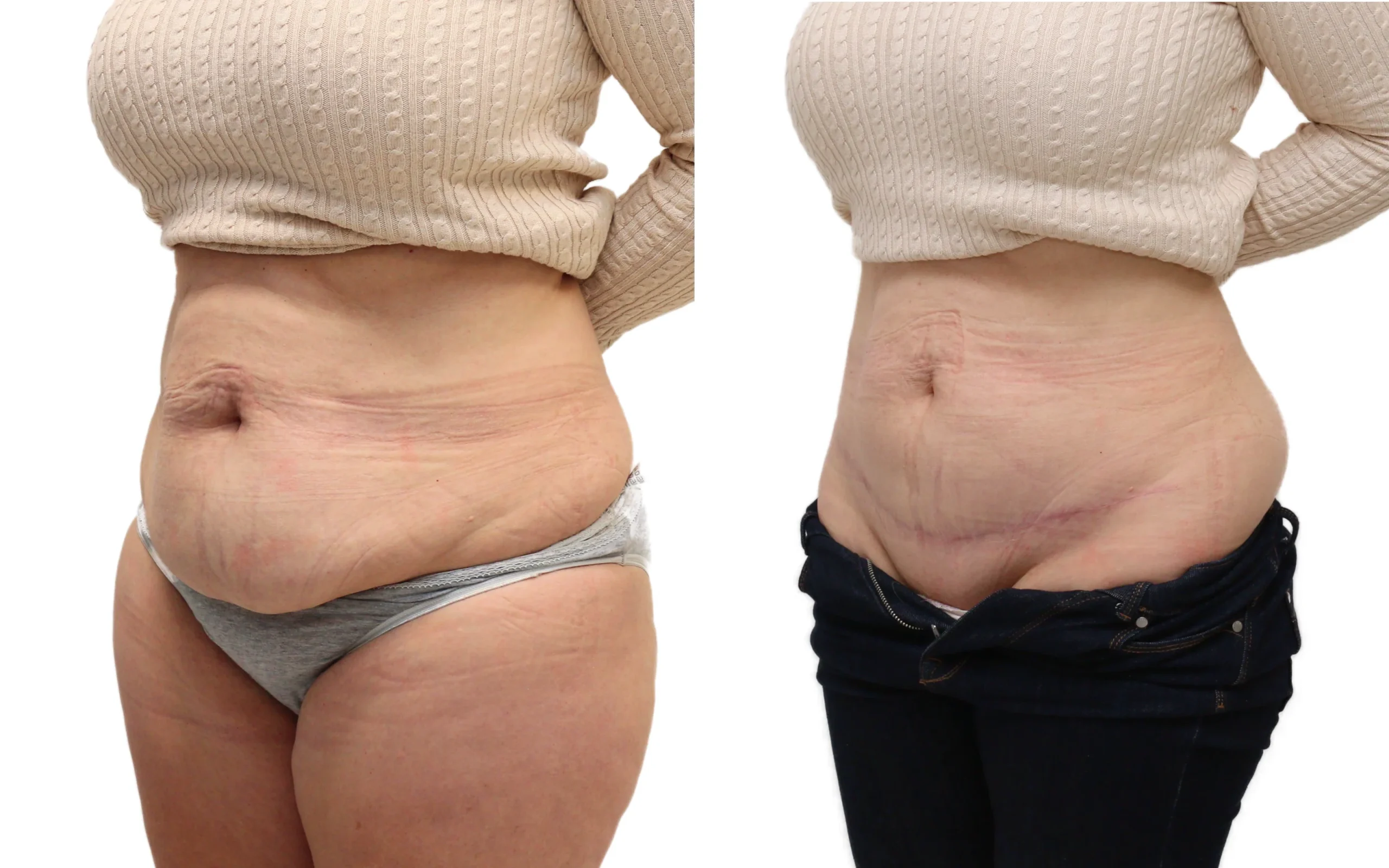 lipo or tummy tuck after c section Can a Improve a C-Section Scar? Could my c-section shelf be