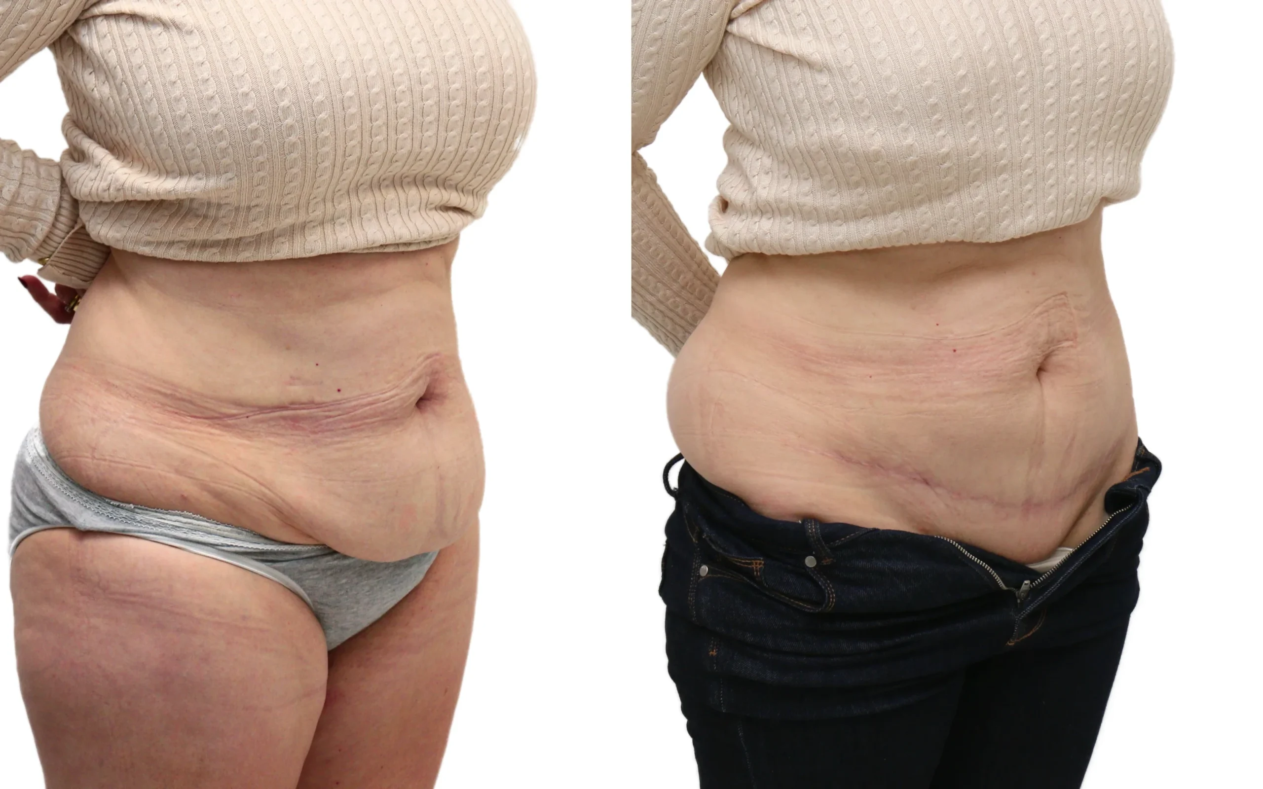lipo on c section pouch Tummy Tuck Results Edinburgh & Scotland Size:55ml Gamma butyrobetaine 10 mg, new-flavor
