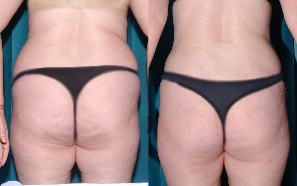 thigh and back liposuction glasgow edinburgh