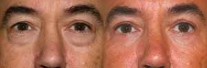 eyebag removal photos uk