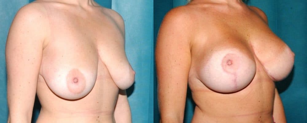 Breast lift and breast asymmetry