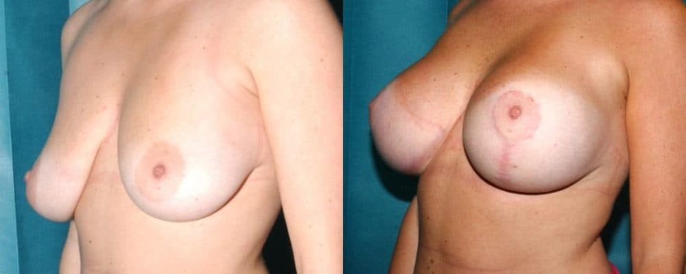 Breast lift and breast asymmetry