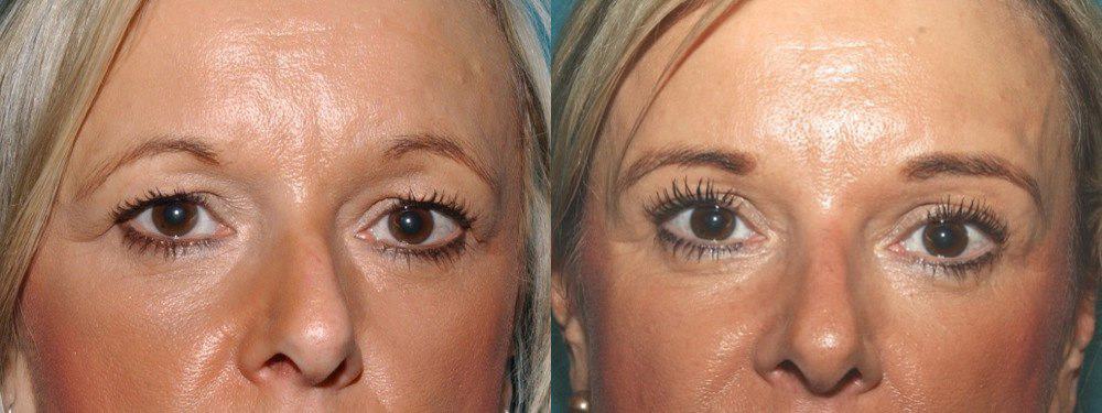 Brow lift with upper eyelid surgery
