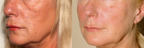 dermal fillers edinburgh