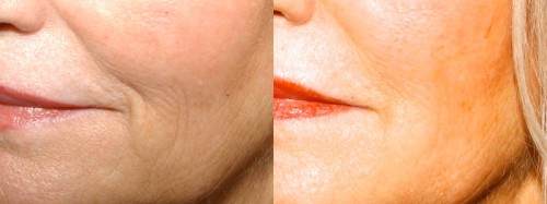 Mouth fillers edinburgh