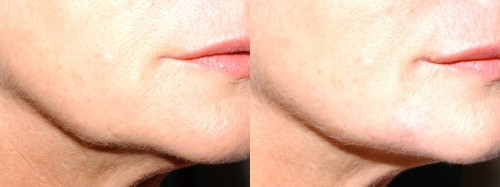 fillers for jowls edinburgh