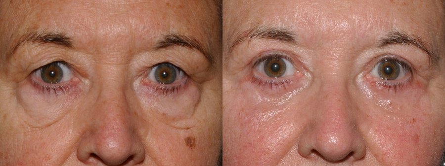 eyelid surgery edinburgh