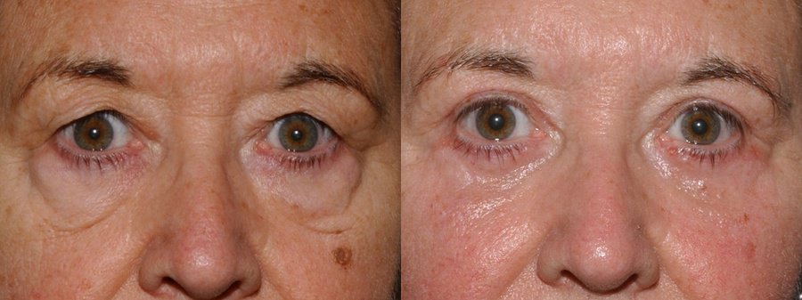 eyelid surgery edinburgh