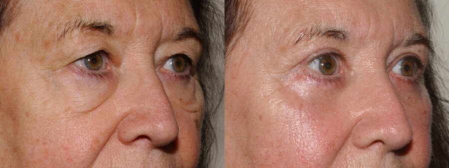 eyelid surgery glasgow edinburgh