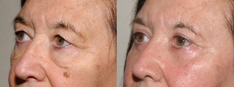 Upper and lower blepharoplasty with fat transfer to cheeks