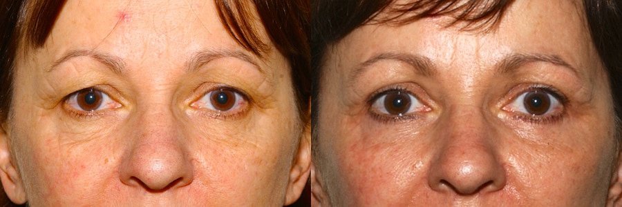 Upper and lower eyelid surgery with fat transfer