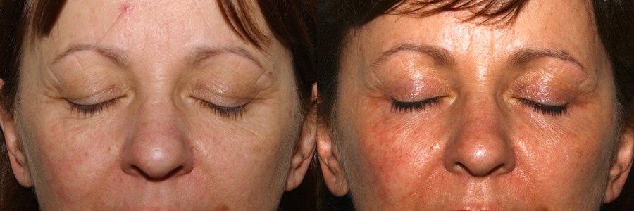 Upper and lower eyelid surgery with fat transfer