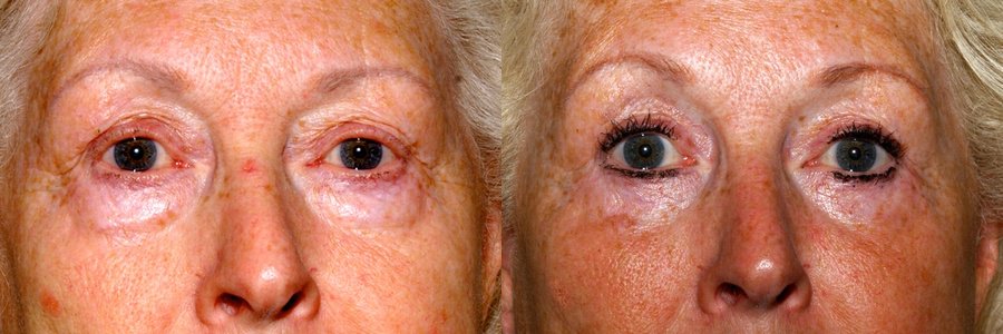 eyebag removal glasgow