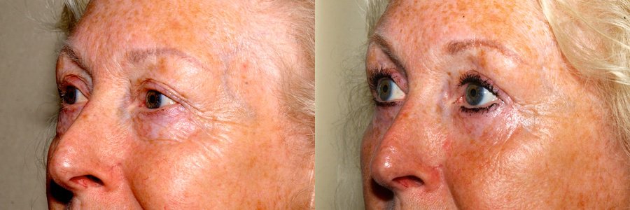 blepharoplasty before and after uk