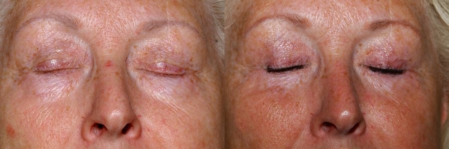 Revision lower eyelid surgery