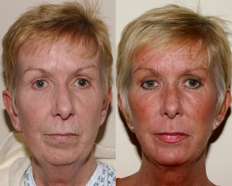 Face lift, chin implant and fat transfer
