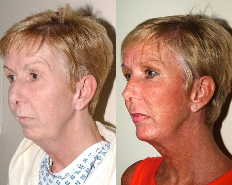 Face lift, chin implant and fat transfer