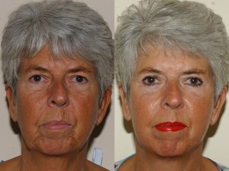 facelift, eyelid surgery and fat transfer