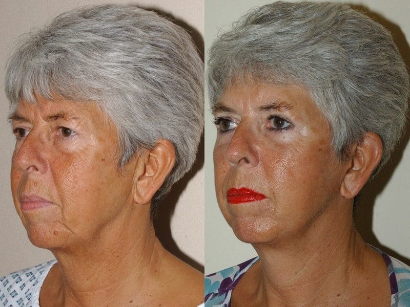 facelift, eyelid surgery and fat transfer