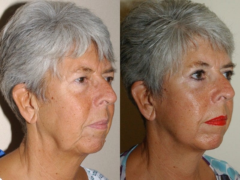 facelift, eyelid surgery and fat transfer