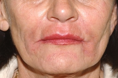 peri-oral wrinkles - immediately after