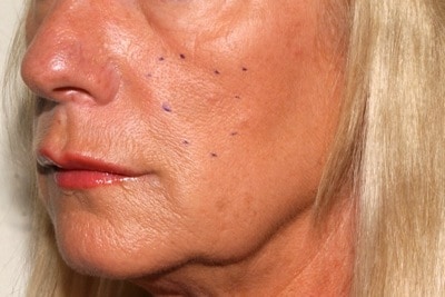 cheek filler - before