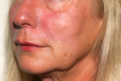 cheek filler - immediately after