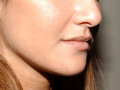 Juviderm lip injection - before