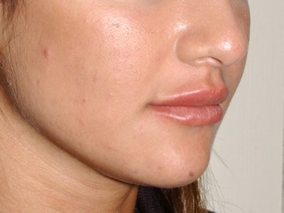 Juviderm lip injection - immediately after