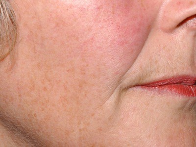 nasolabial folds - before