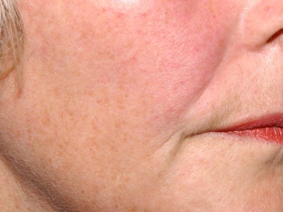 nasolabial folds - after