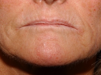 mouth wrinkles - before