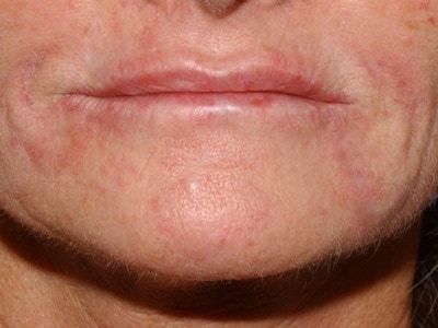 mouth wrinkles - immediately after