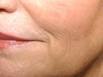 corner of mouth - before
