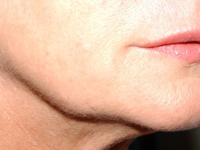 fillers for jowls - before