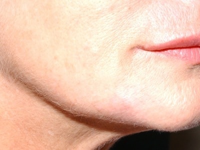 fillers for jowls - after