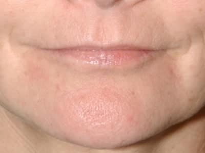 lip fillers - before