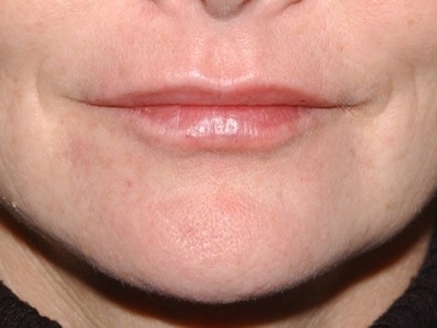 lip fillers - after
