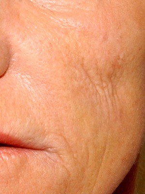 hyaluronic acid cheeks - before