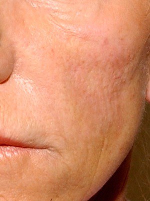 hyaluronic acid cheeks - immediately after