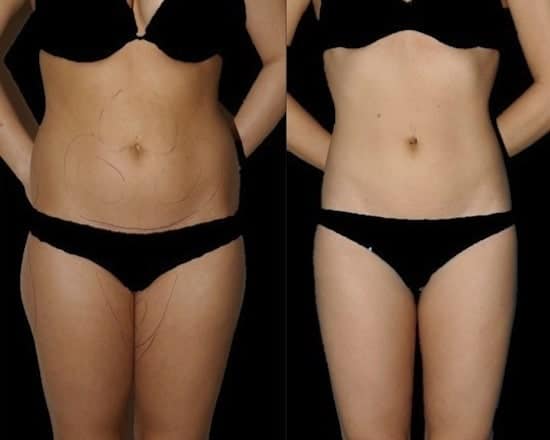 Tummy, hip and thigh liposuction