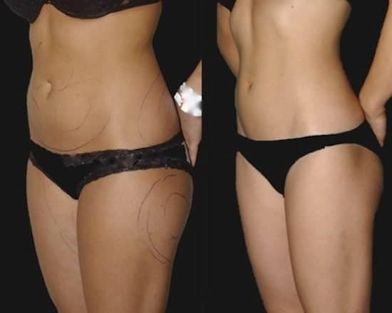 Tummy, hip and thigh liposuction