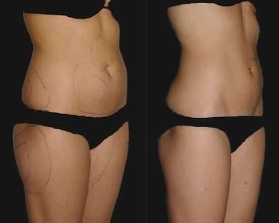 Tummy, hip and thigh liposuction