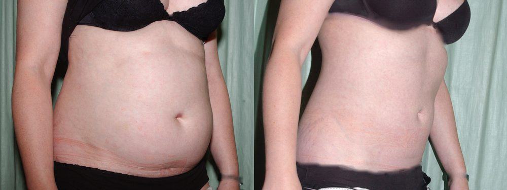 liposuction scotland