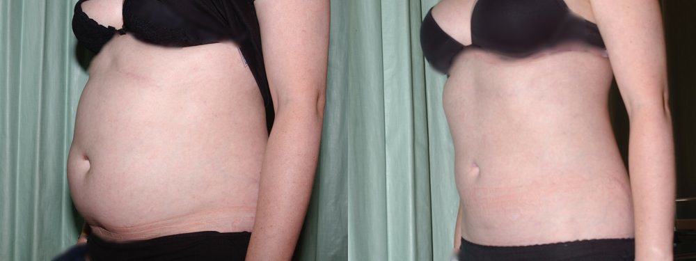 liposuction glasgow edinburgh