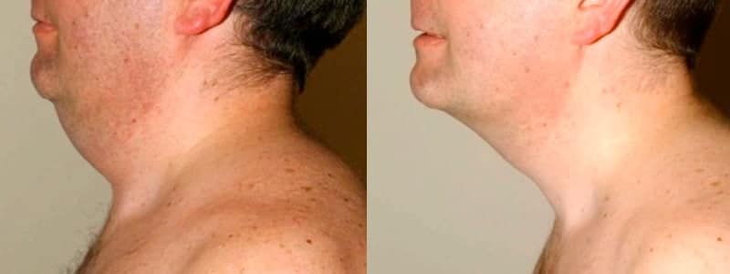 neck liposuction scotland before and after