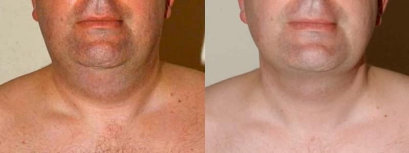 neck liposuction glasgow