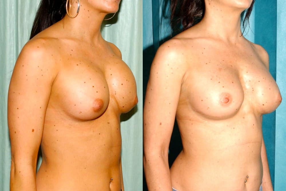 before and after revision breast implants