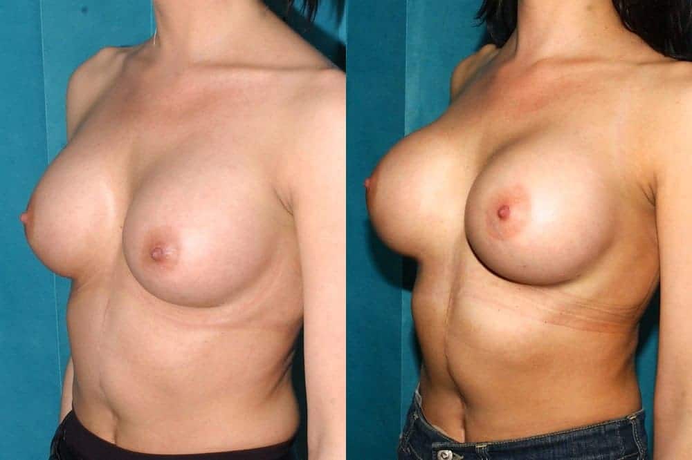 Correction of high riding implants and up-sizing