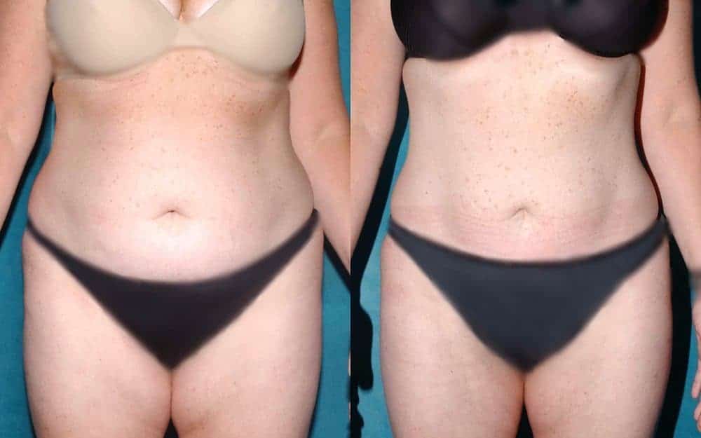 abdominal liposuction glasgow edinburgh